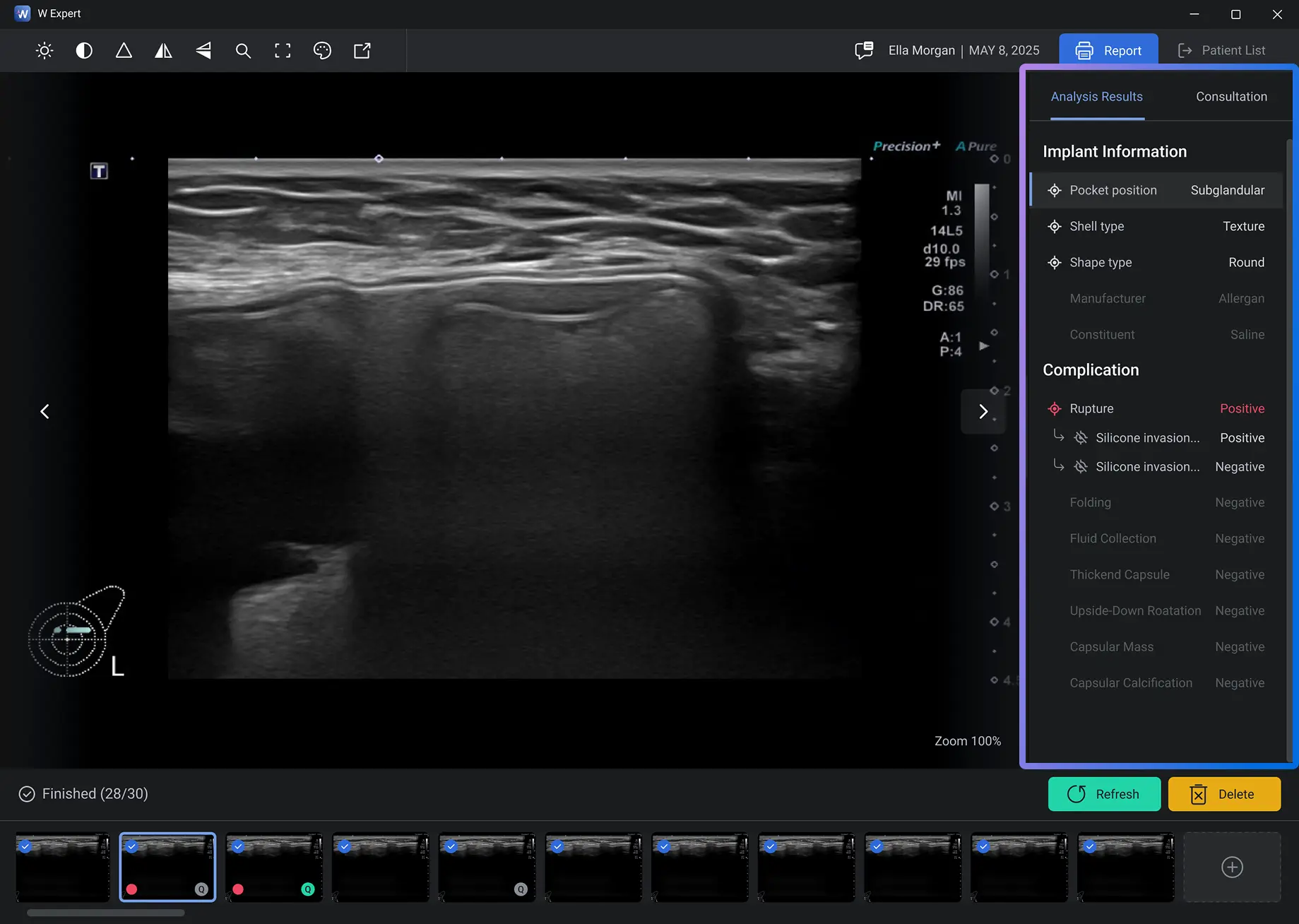 Implant Information Analysis